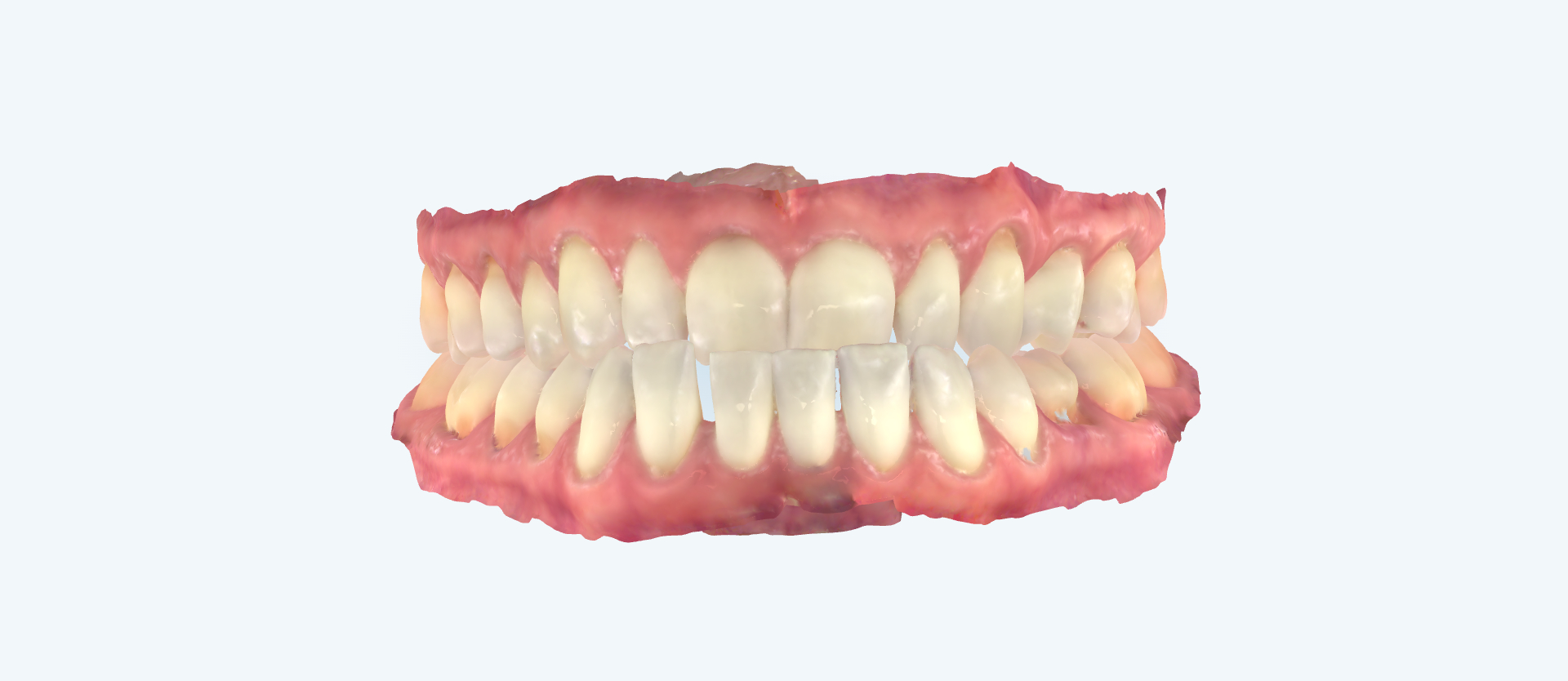 Underbite treatment comparison side view before